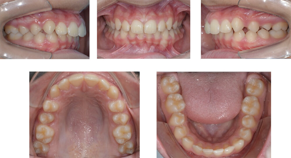 Fig. 1. Fotos intraorales iniciales del paciente, visión derecha, frontal, izquierda, oclusal superior e inferior.