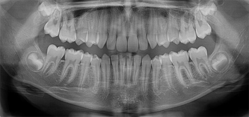 Fig. 2. Fotos de radiografía panorámica.