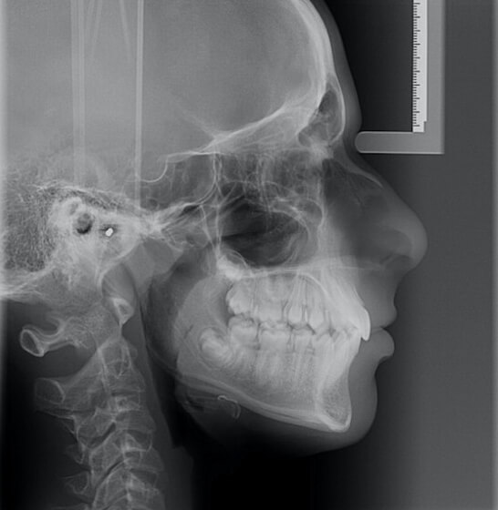 Fig.3. Foto radiografía teleradiografías de perfil y tabla de medidas cefalométricas previo al tratamiento con el sistema de alineadores.