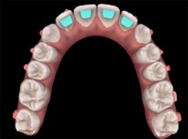 Fig.5. .b)Imagen presencia de rampas de mordidas desde el alineador número 9.