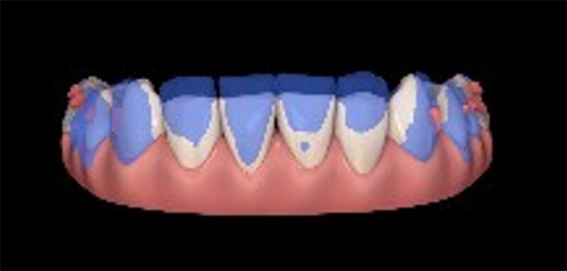 Fig. 6. Fotos de ClinCheck de superposición del movimiento de dientes inferiores.