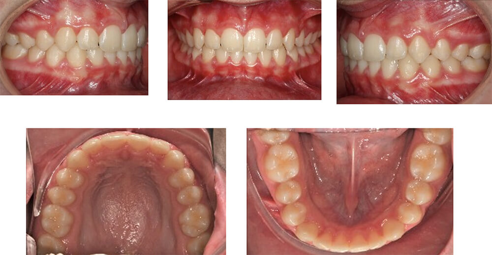 Fig. 5. Fotos clínicas intraorales posterior al tratamiento de 15 meses de uso de alineadores Invisalign.