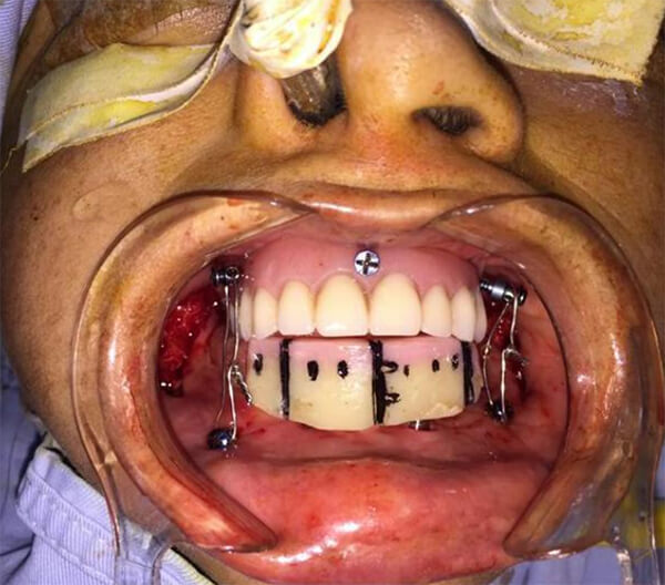 Figura 4. Fijación con tornillos intermaxilares laterales maxilares y mandibulares, y tornillo anterior de osteosíntesis para estabilizar prótesis maxilar, guía protésica, con estabilidad de implantes anteriores, fijación con alambre para establecer la relación maxilo-mandibular.