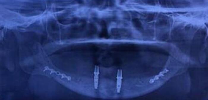 Figura 5: Radiografía posquirúrgica con colocación de implantes y placas de osteosíntesis.