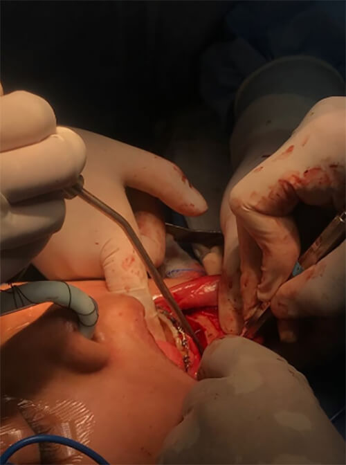 Fig. 11 separación del mentón del cuerpo mandibular.