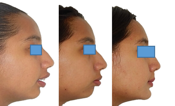 Fig. 13 perfil inicio, progreso, final.