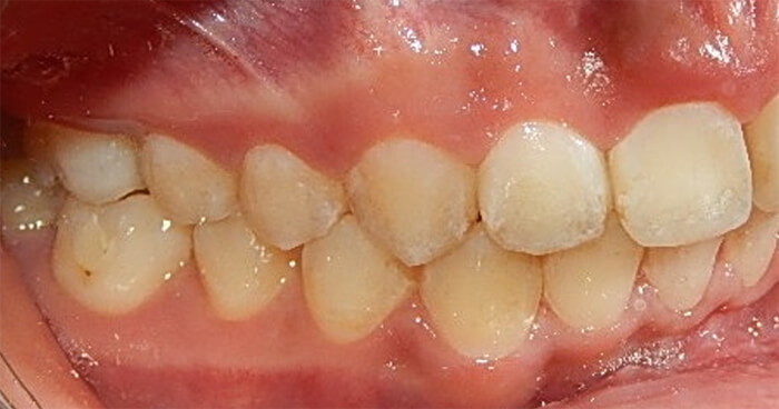 Fig.15 lado derecho clase I molar y canino.