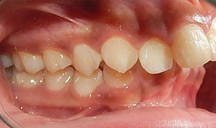 Fig. 4 izquierda clase II canina y molar.