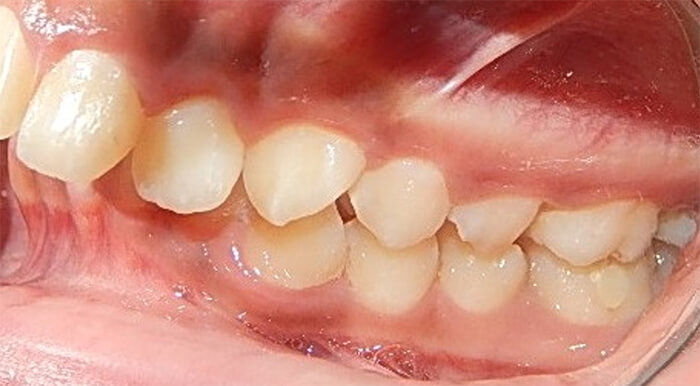 Fig. 5 derecha clase II canina y molar.