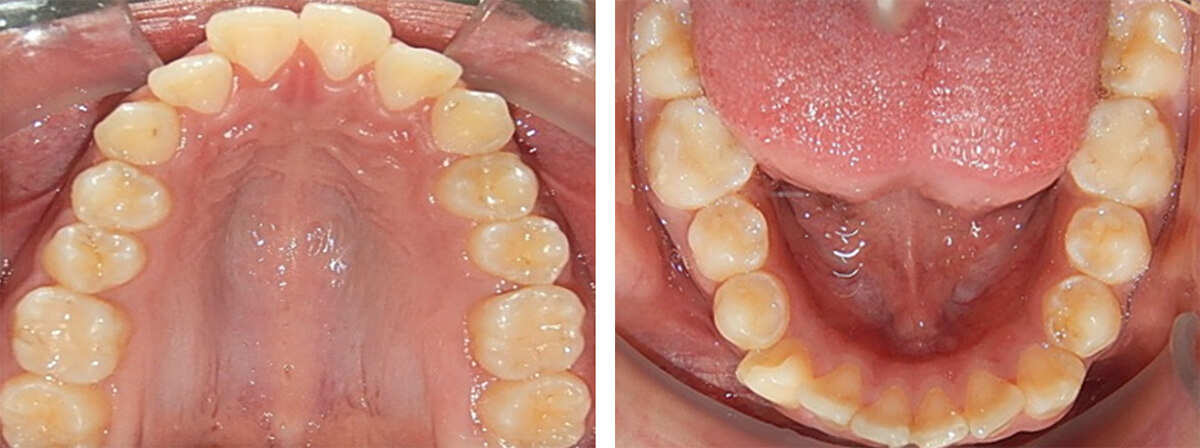 Fig. 6 Vista Oclusal arcadas superior e inferior.