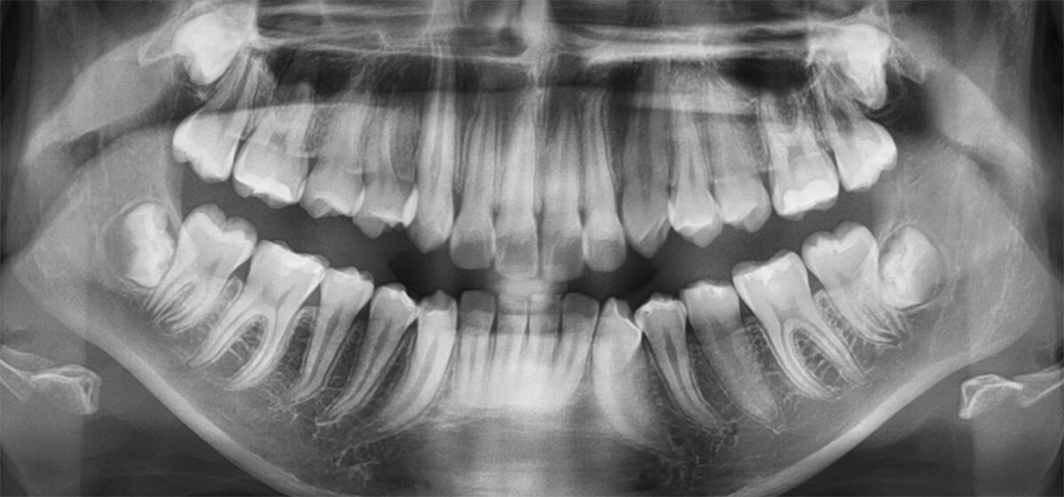 Fig. 7 Rx Panorámica.