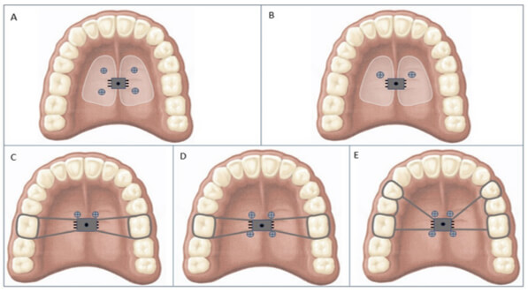 Esquema 1.- A) cuatro microtornillos sin bandas, B) dos microtornillos sin bandas, C) dos microtornillos y dos bandas, D) cuatro microtornillos y dos bandas, E) cuatro microtornillos y cuatro bandas.