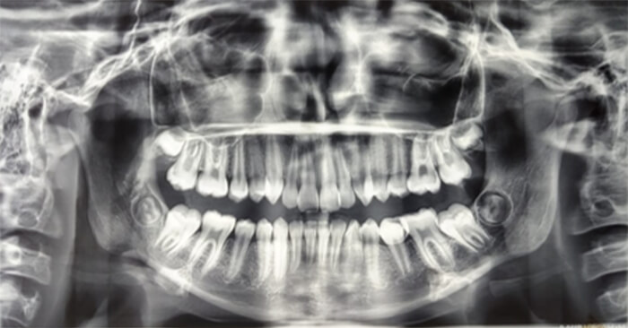 Figura 2. Radiografía panorámica y lateral de inicio