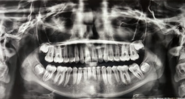 Figura 5. Radiografías panorámica y lateral de cráneo finales