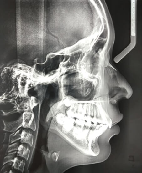 Figura 5. Radiografías panorámica y lateral de cráneo finales