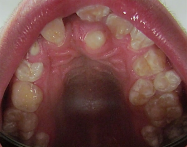 Fig. 2.- Fotografía intraoral de dientes supernumerarios en arcada superior