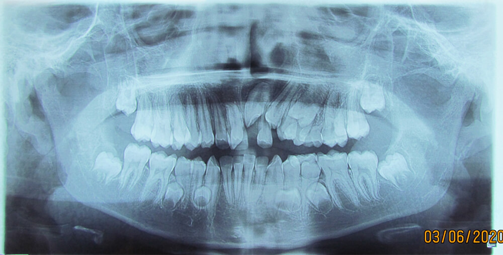 Fig. 3.- Radiografía panorámica, estructuras óseas maxilares y mandibulares en aparente normalidad, cronología de erupción adecuada. Ausencia de alteraciones en la formula dental.