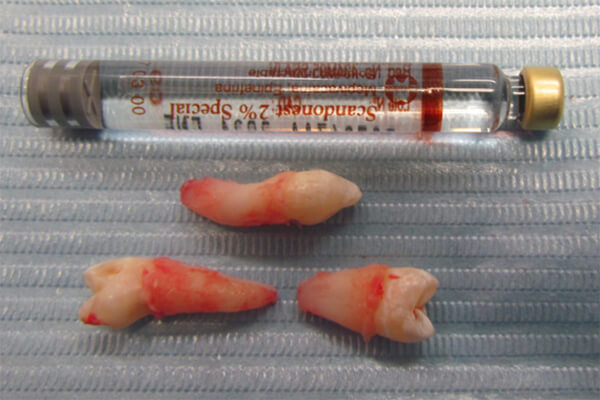 Fig. 4.- Dientes supernumerarios del cuadrante superior derecho.