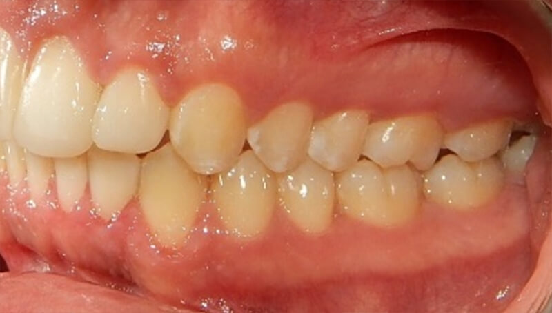 Fig. 11 Relación molar, canina Clase I