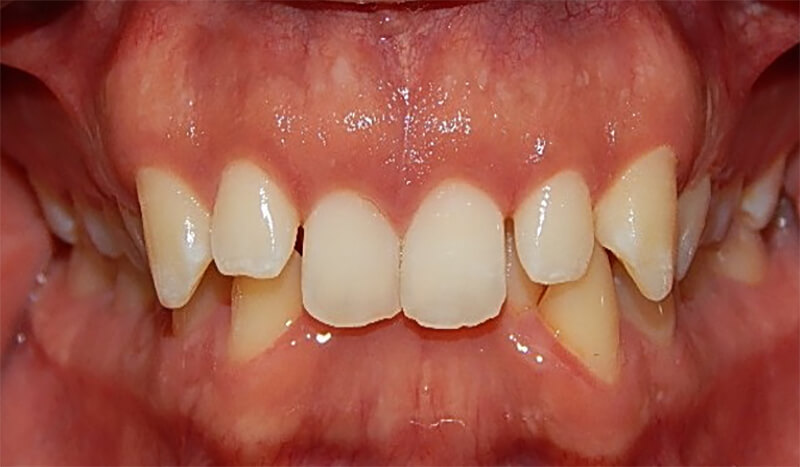 Fig. 2 Frente oclusal inicio