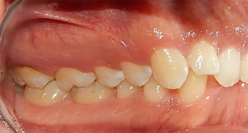 Fig. 3. Intraoral lateral derecha