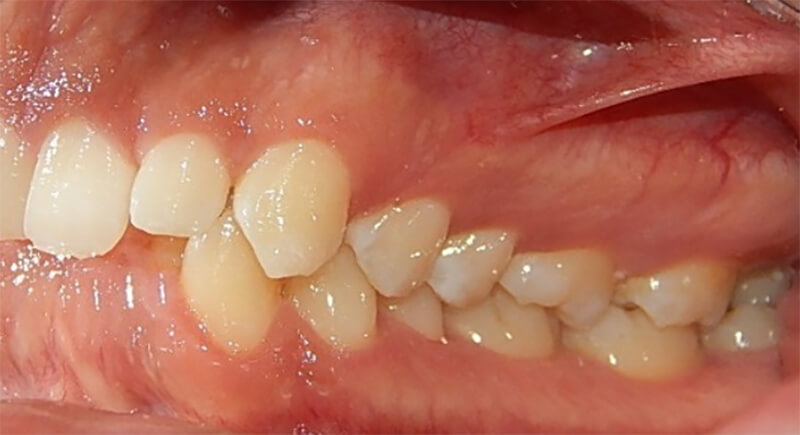 Fig.4. Intraoral lateral izquierda