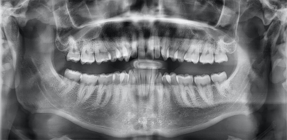 Fig. 5 Radiografía panorámica