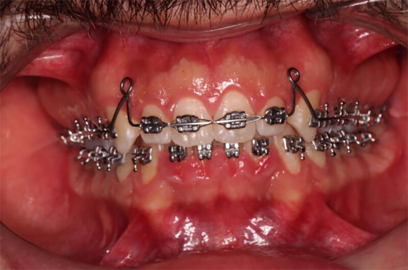 Fig.7 Ansas de retracción anterosuperior