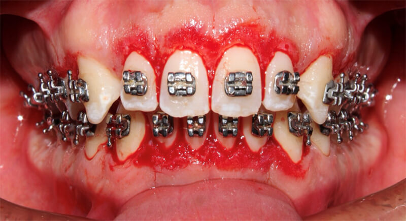 Fig. 8 Gingivoplastía