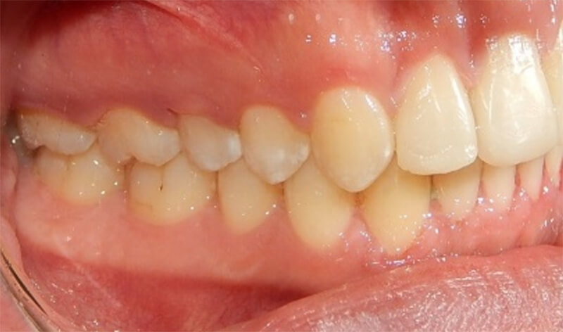 Fig. 9 molar y canina Clase I