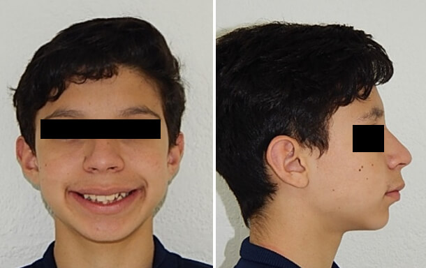 Fig.1 Extraoral frente sonrisa, perfil inicio