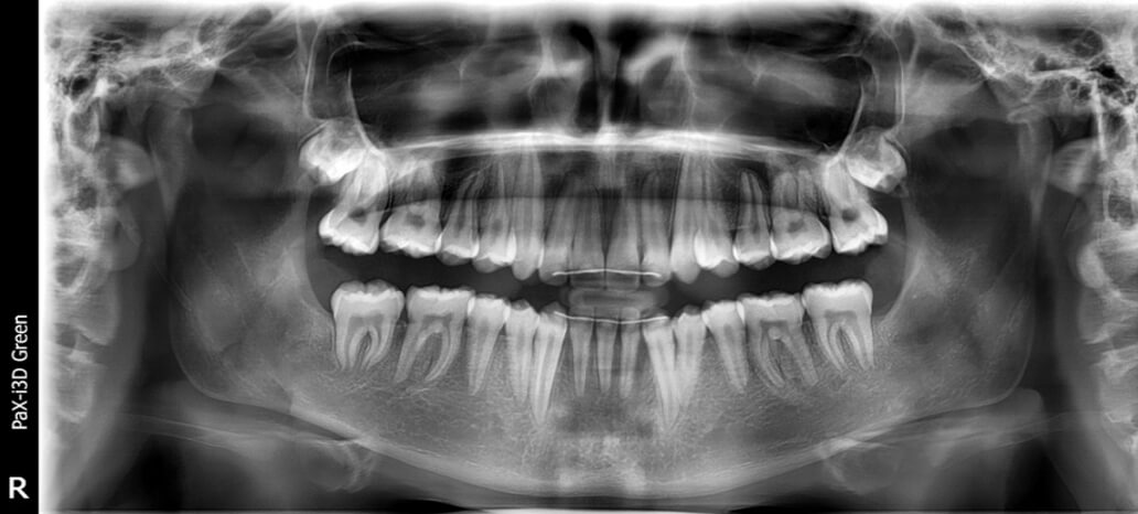 Fig.11 Radiografía panorámica final