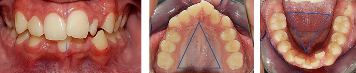 Fig.3 Intraoral de frente inicio oclusal  superior e inferior