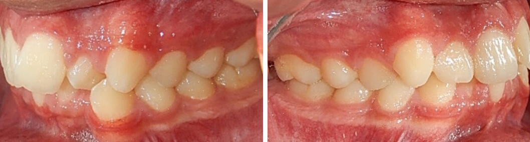 Fig. 4 lateral izquierda y derecha  inicio