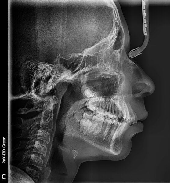 Fig.5 Radiografía lateral de cráneo inicio