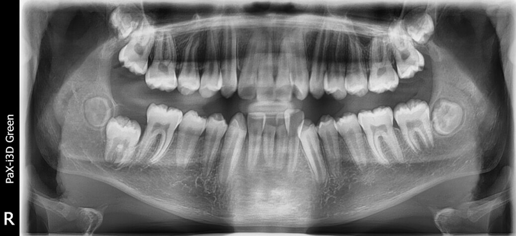 Fig.6 Radiografía panorámica inicio