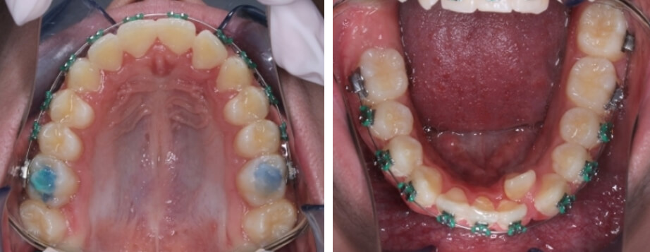 Fig. 7 Intraoral oclusal superior e inferior de progreso