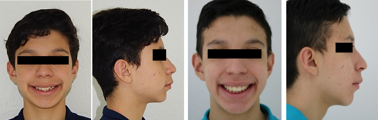 Fig. 8 comparación de frente, perfil inicio final