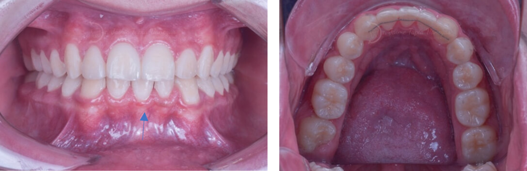 Fig. 9 Intraoral frente final vista oclusal inferior