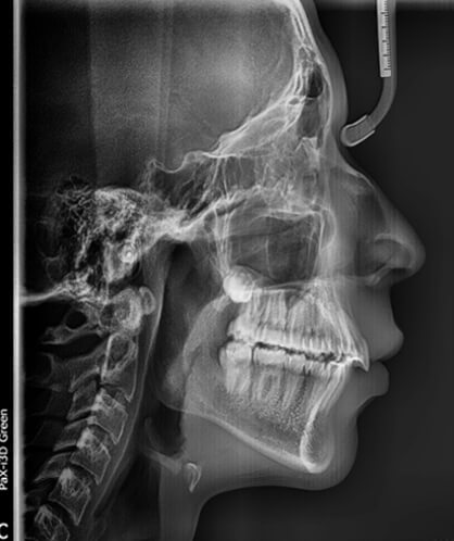 Fig.10 Radiografía lateral de cráneo final