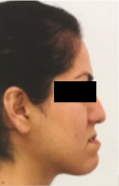 Fig. 1 Extraoral de perfil