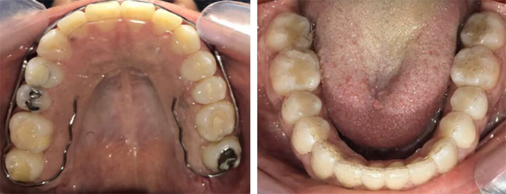 Fig. 10 oclusales retenedor superior circunferencial, termoformado inferior