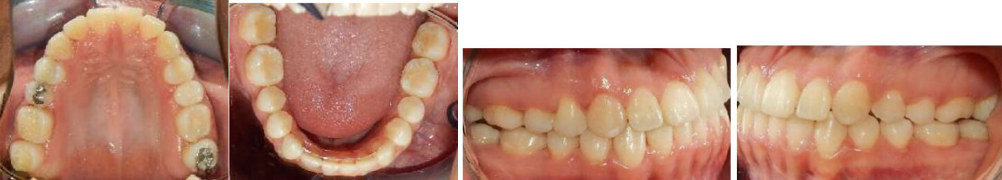 Fig. 12 Vista oclusal superior e inferior final derecha izquierda