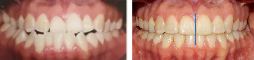 Fig. 13 Intraoral comparación de frente inicio final