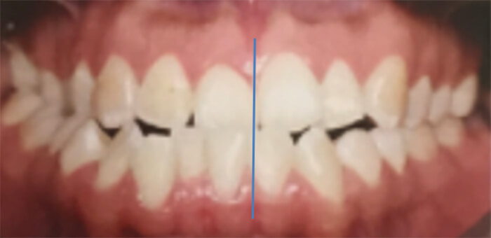 Fig. 2 Intraoral de frente