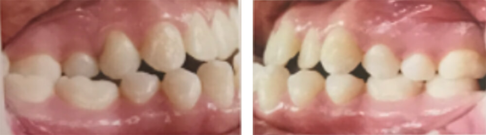 Fig. 3 derecha e izquierda