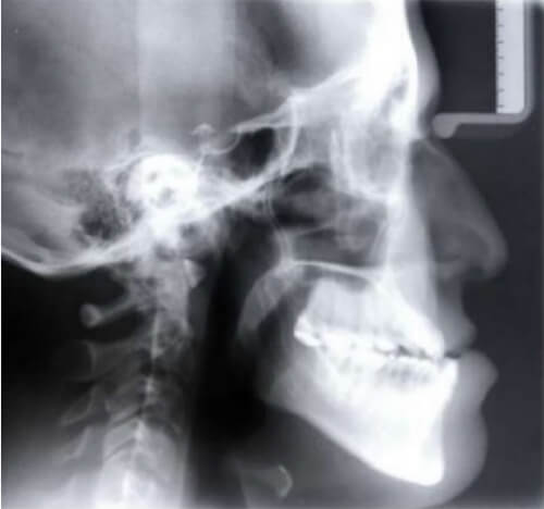 Fig. 6 Radiografía lateral de cráneo