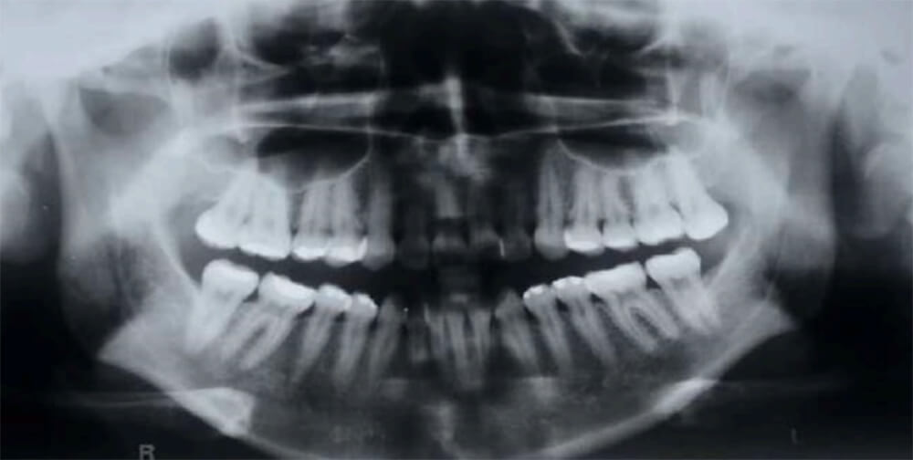 Fig.7 Radiografía Panorámica