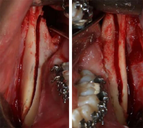 Fig. 9 Osteotomía de rama derecha, izquierda