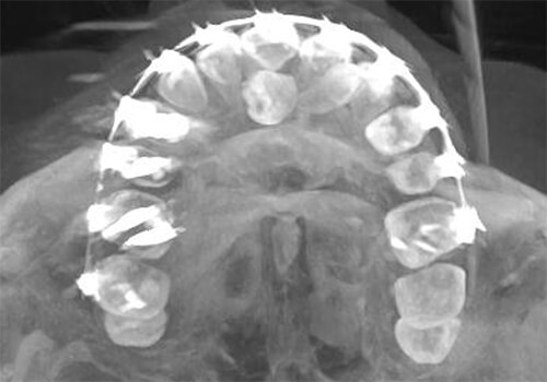 Fig. 7 Diente supernumerario